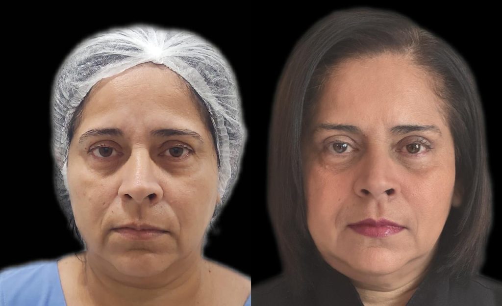 Blefaroplastia - Antes e Depois. Dra Adriana Melo